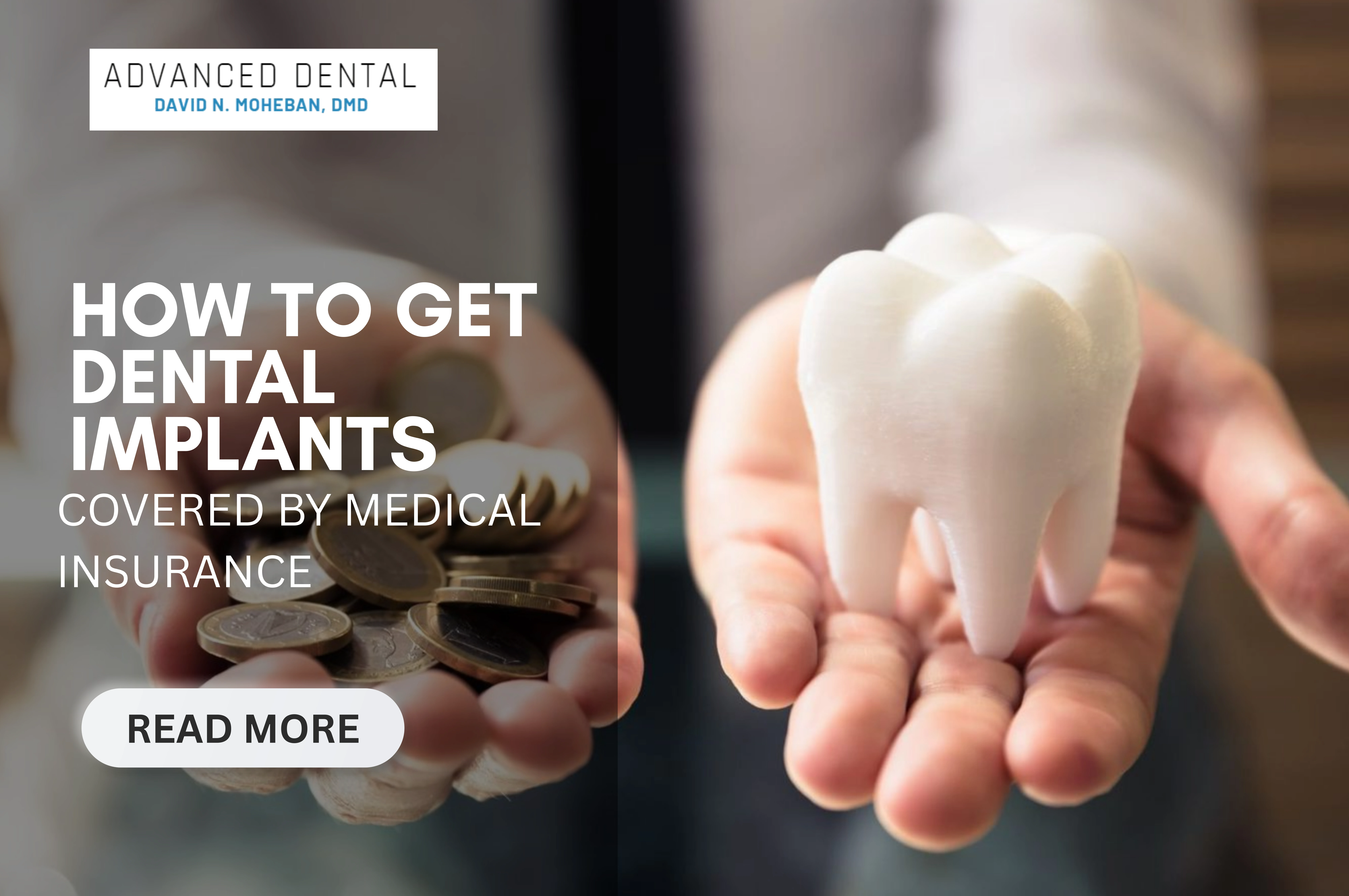 How To Get Dental Implants Covered By Medical Insurance