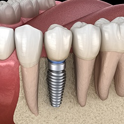 Dental Implant-Missing Single Tooth