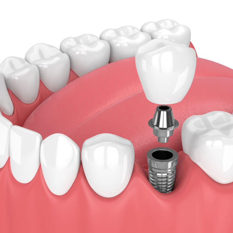 Dental Implants Westborough MA