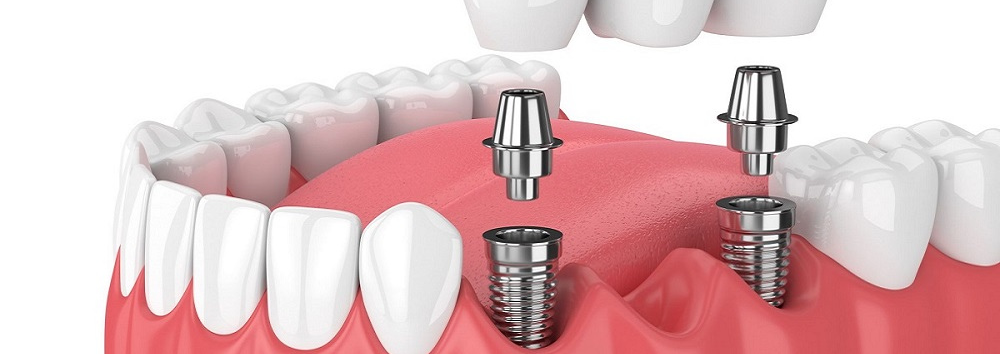 Best Dental Implants Solution in Westborough