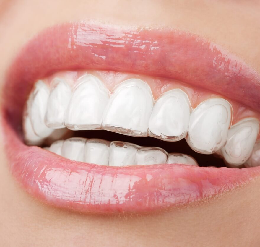 Invisalign Treatment