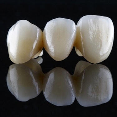 Metal-Free Restorations