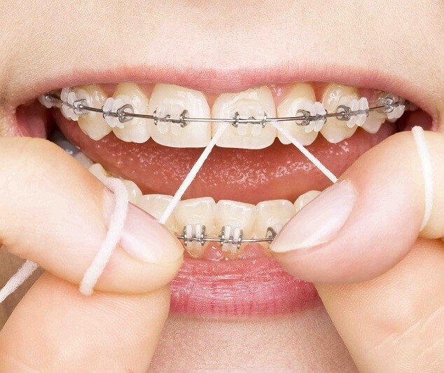 Porcelain Veneers