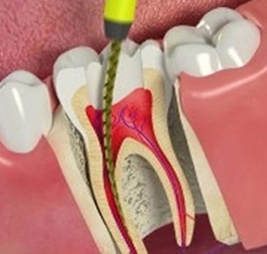 Signs That You Need a Root Canal