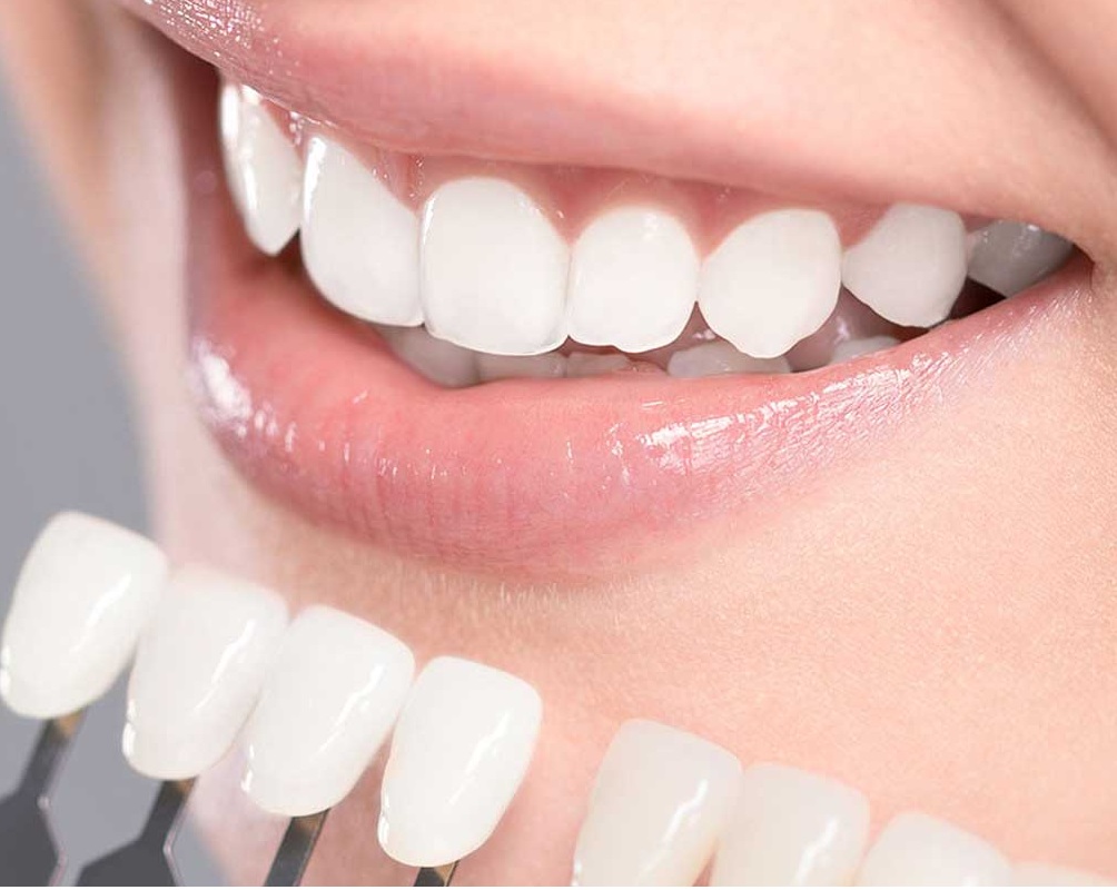 Teeth whitening Westborough ma