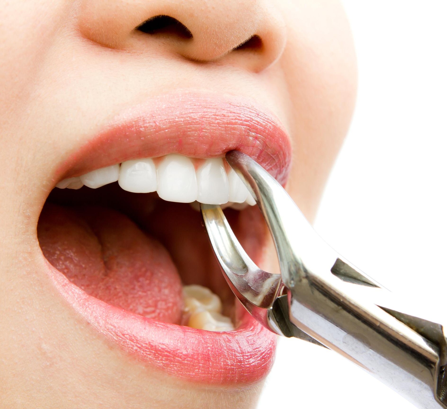 Tooth Extractions Treatment