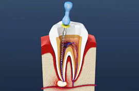 Root Canal Therapy